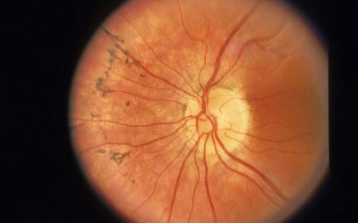 retinitis-pigmentosa.2